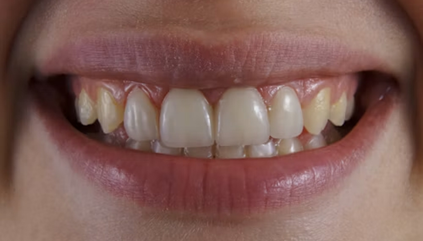 Prevention of Tooth Decay