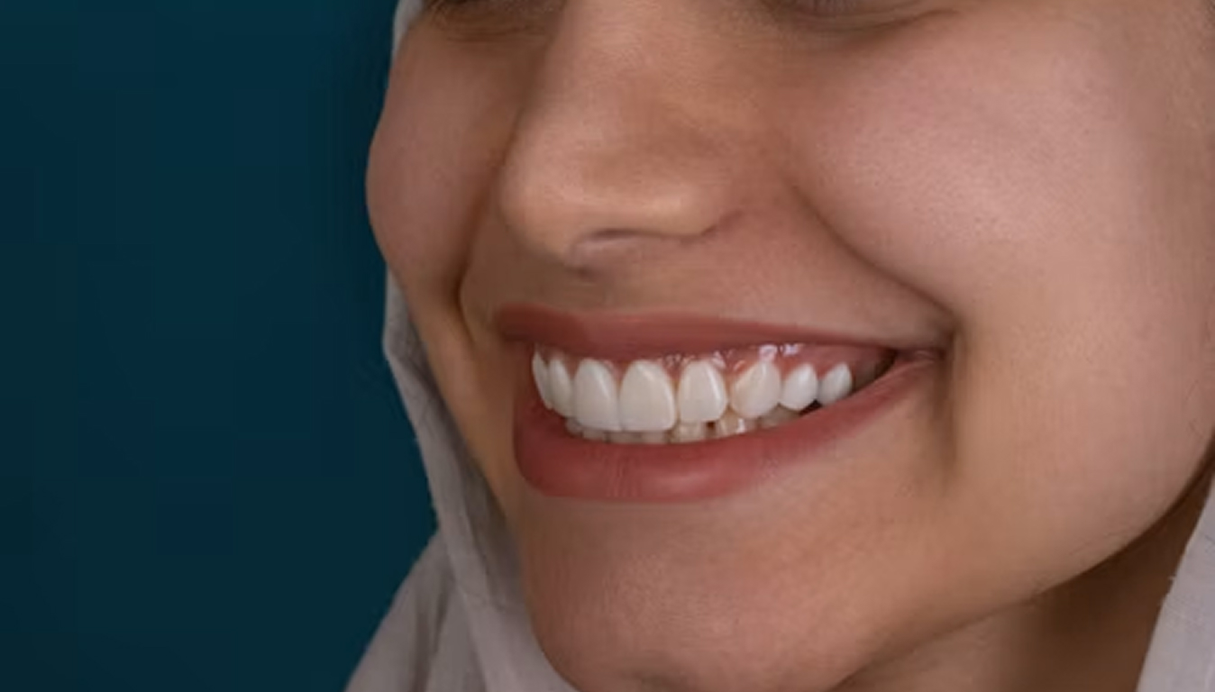 Teeth Whitening